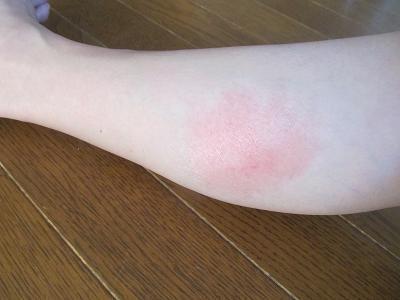 虫さされ